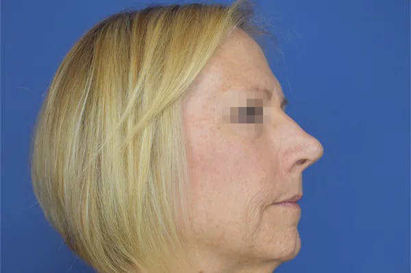 Rhinoplasty Before & After Gallery - Patient 13574726 - Image 5
