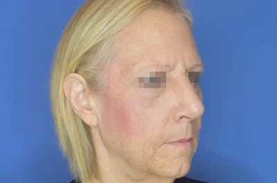 Rhinoplasty Before & After Gallery - Patient 13574726 - Image 6