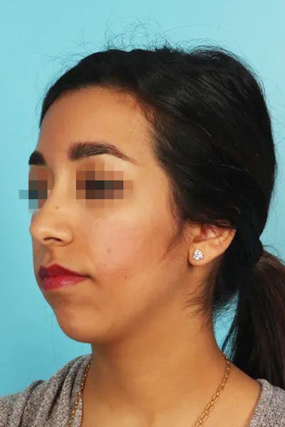 Chin Implant Before & After Gallery - Patient 13574731 - Image 1