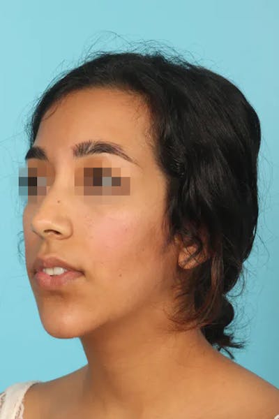 Chin Implant Before & After Gallery - Patient 13574731 - Image 2