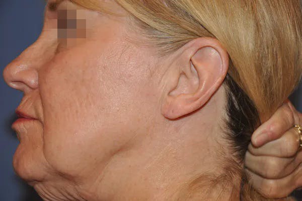Earlobes Before & After Gallery - Patient 13574735 - Image 2