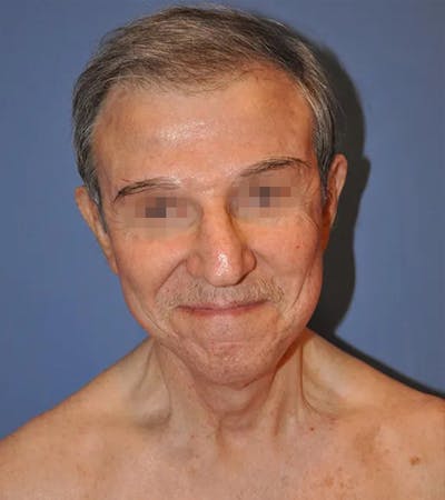 Facelift Before & After Gallery - Patient 13574737 - Image 2