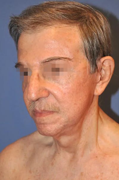 Facelift Before & After Gallery - Patient 13574737 - Image 4