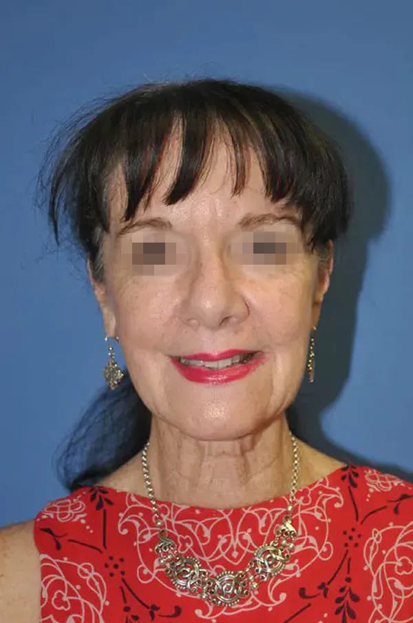 Facelift Before & After Gallery - Patient 13574738 - Image 1