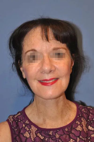 Facelift Before & After Gallery - Patient 13574738 - Image 2