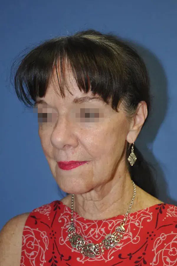 Facelift Before & After Gallery - Patient 13574738 - Image 3