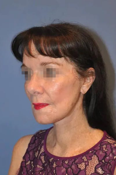 Facelift Before & After Gallery - Patient 13574738 - Image 4