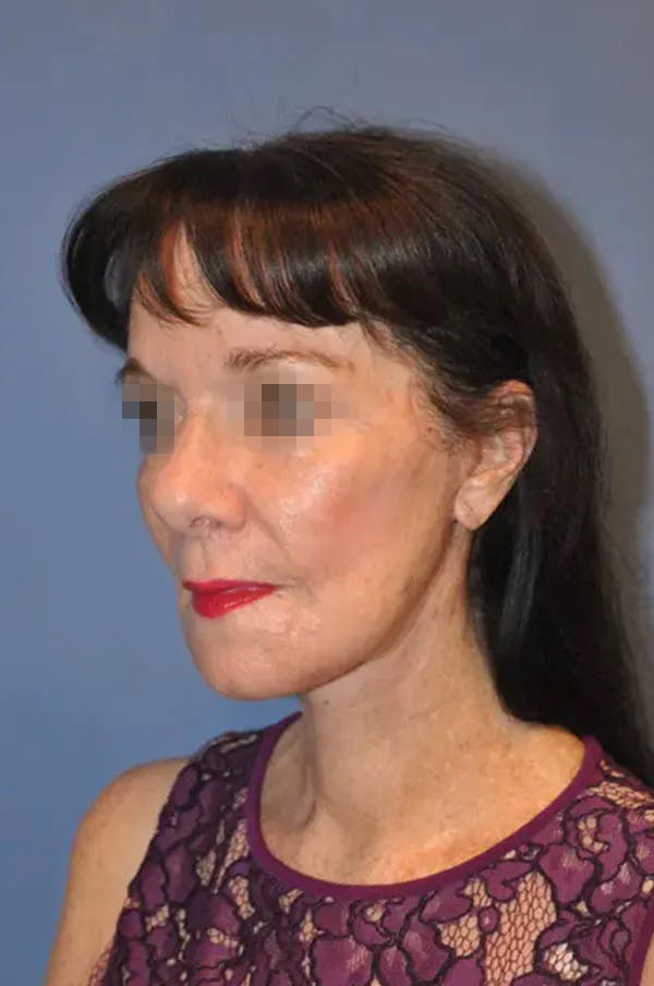 Facelift Before & After Gallery - Patient 13574738 - Image 4