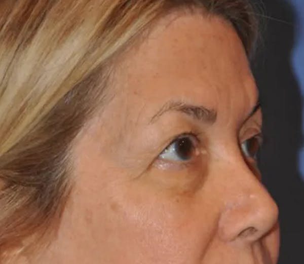 Brow Lift Before & After Gallery - Patient 13574743 - Image 3