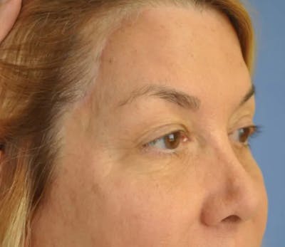 Brow Lift Before & After Gallery - Patient 13574743 - Image 4