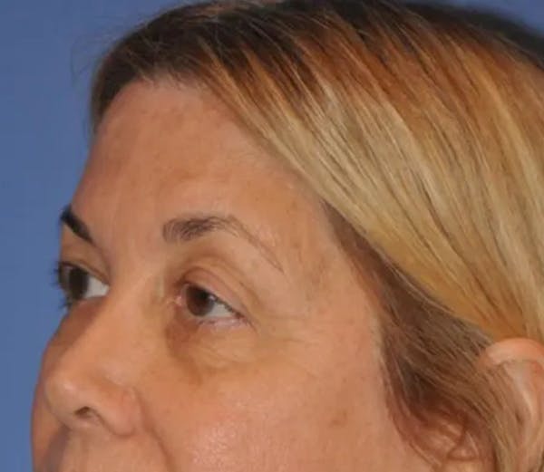 Brow Lift Before & After Gallery - Patient 13574743 - Image 5