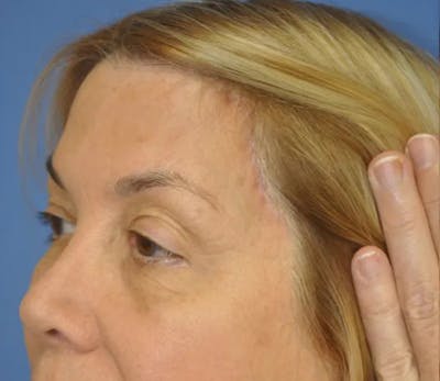 Brow Lift Before & After Gallery - Patient 13574743 - Image 6