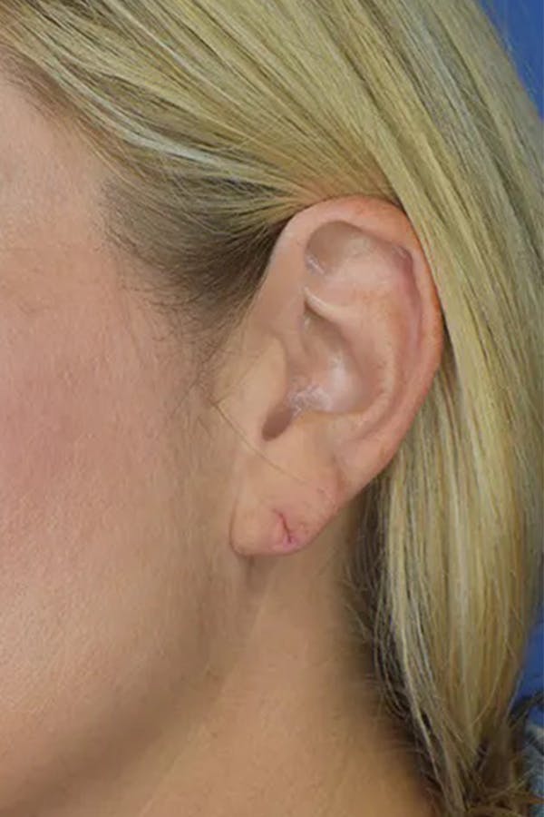 Earlobes Before & After Gallery - Patient 21023809 - Image 1