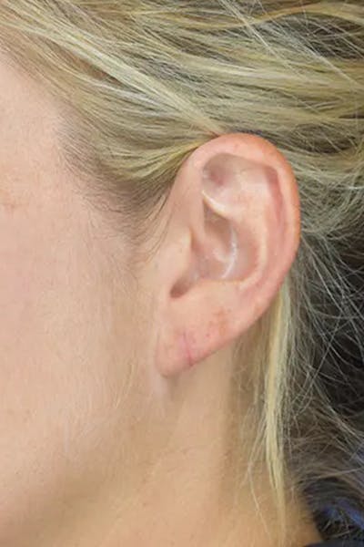 Earlobes Before & After Gallery - Patient 21023809 - Image 2