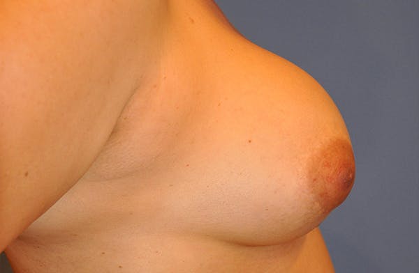 Breast Revision Before & After Gallery - Patient 22975744 - Image 5