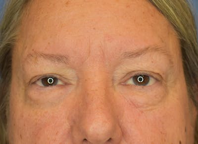 Blepharoplasty (Eyelid Surgery) Before & After Gallery - Patient 22978210 - Image 1