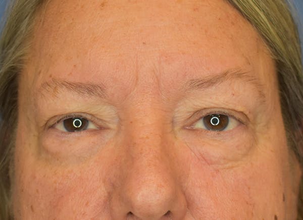 Blepharoplasty (Eyelid Surgery) Before & After Gallery - Patient 22978210 - Image 1