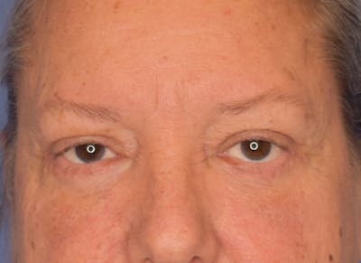 Blepharoplasty (Eyelid Surgery) Before & After Gallery - Patient 22978210 - Image 2