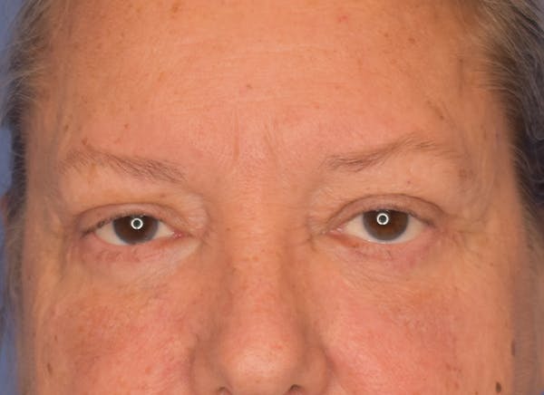 Blepharoplasty (Eyelid Surgery) Before & After Gallery - Patient 22978210 - Image 2