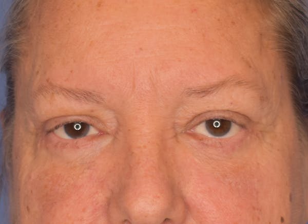 Blepharoplasty (Eyelid Surgery) Gallery - Patient 22978210 - Image 2