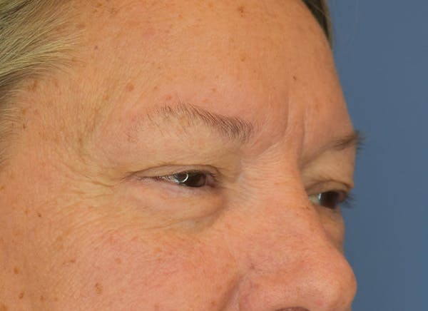 Blepharoplasty (Eyelid Surgery) Before & After Gallery - Patient 22978210 - Image 3