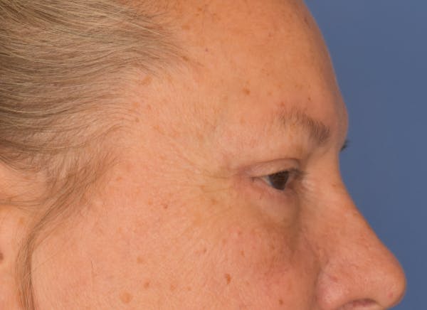 Blepharoplasty (Eyelid Surgery) Before & After Gallery - Patient 22978210 - Image 4