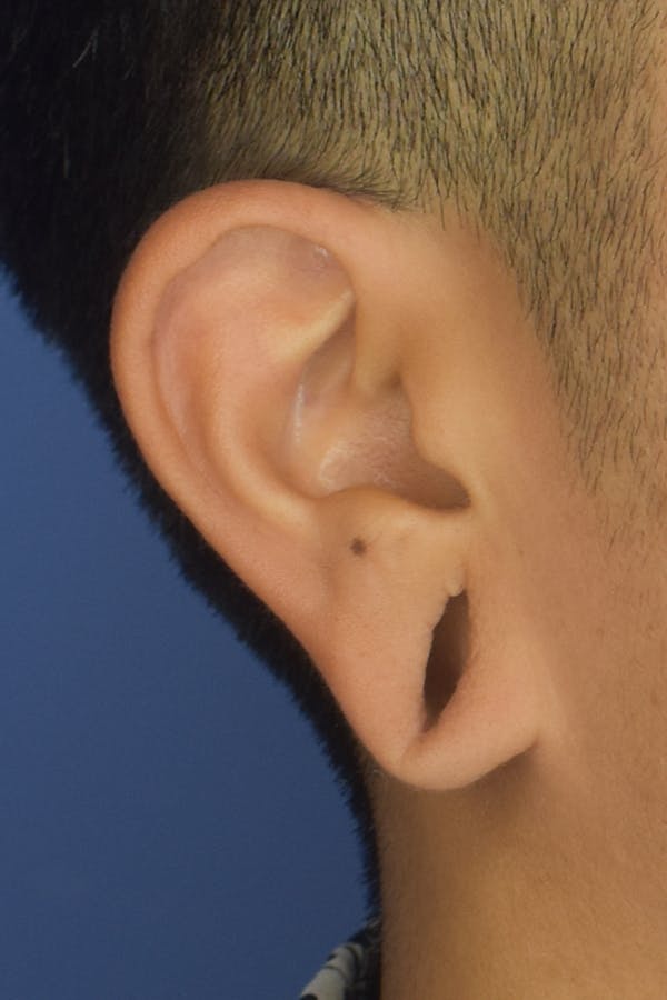 Earlobes Before & After Gallery - Patient 22978215 - Image 1