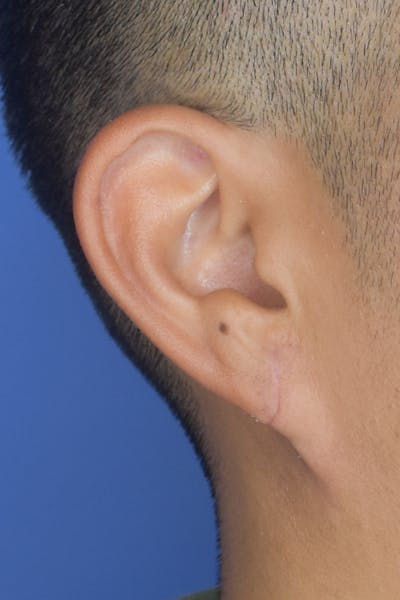Earlobes Before & After Gallery - Patient 22978215 - Image 2