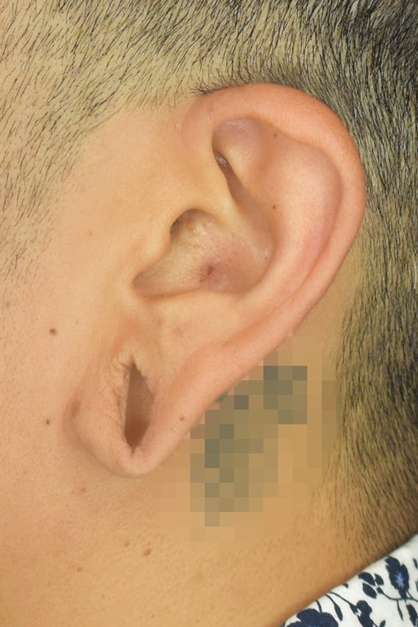 Earlobes Gallery - Patient 22978215 - Image 3