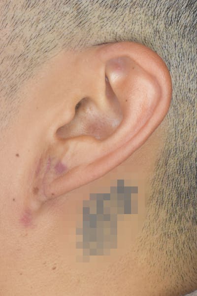 Earlobes Before & After Gallery - Patient 22978215 - Image 4