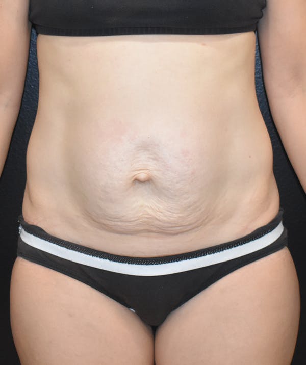 Tummy Tuck (Abdominoplasty) Before & After Gallery - Patient 22978227 - Image 1