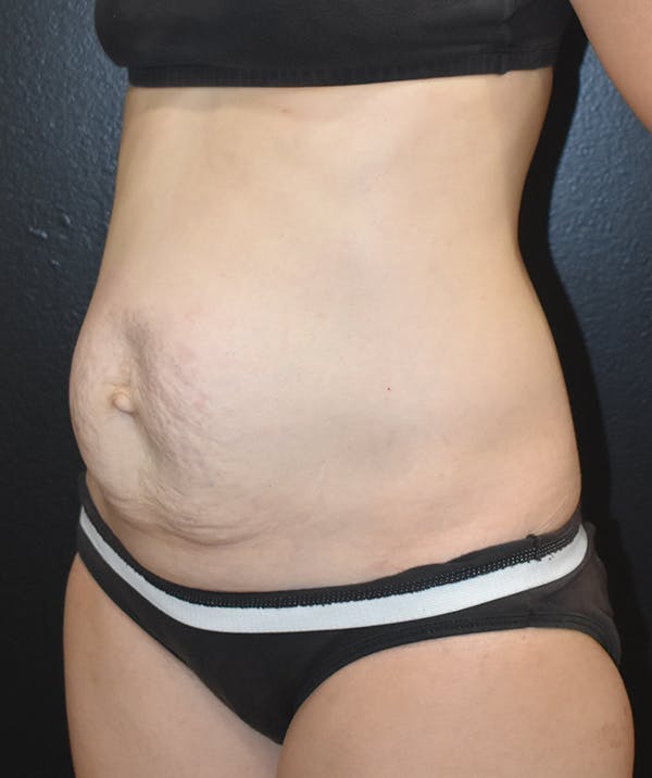 Tummy Tuck (Abdominoplasty) Before & After Gallery - Patient 22978227 - Image 3