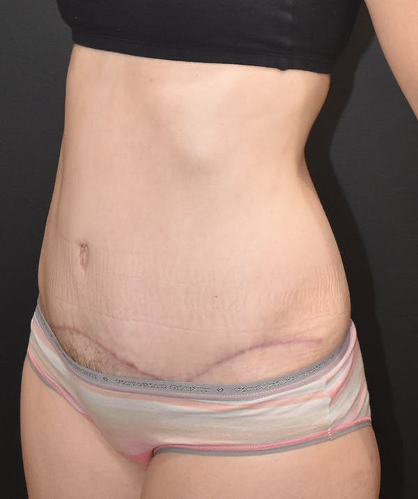 Tummy Tuck (Abdominoplasty) Before & After Gallery - Patient 22978227 - Image 4