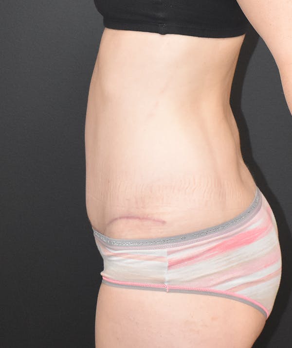 Tummy Tuck (Abdominoplasty) Gallery - Patient 22978227 - Image 6