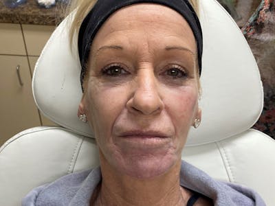 Liquid Facelift Before & After Gallery - Patient 39773925 - Image 2