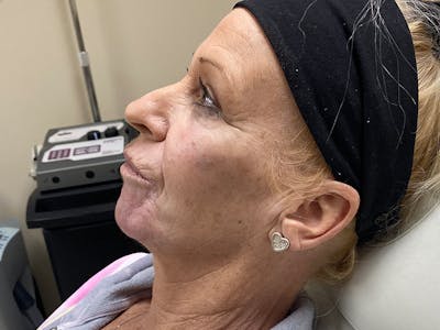 Liquid Facelift Before & After Gallery - Patient 39773925 - Image 4