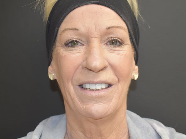 Liquid Facelift Before & After Gallery - Patient 39773925 - Image 1