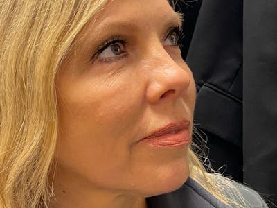 Liquid Facelift Before & After Gallery - Patient 39774034 - Image 4
