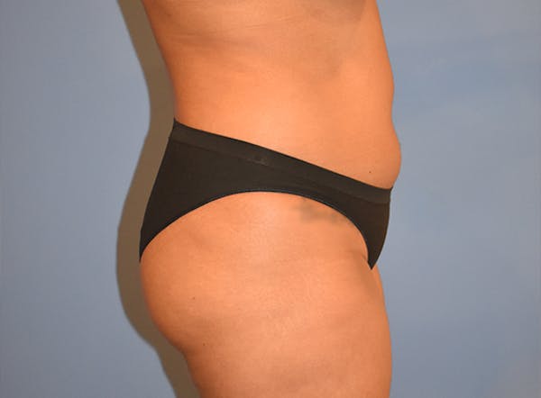 Liposuction Before & After Gallery - Patient 39774183 - Image 3