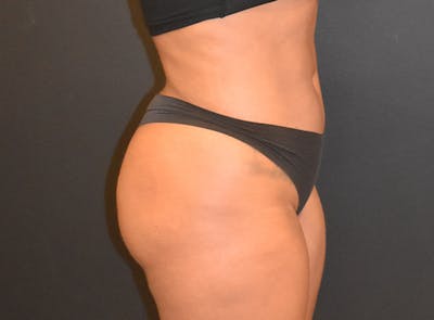 Liposuction Before & After Gallery - Patient 39774183 - Image 4