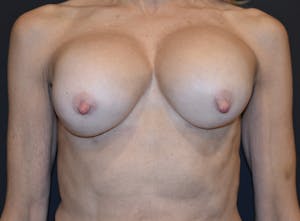 Breast Revision Before and After by Dr. Wirth in Newport Beach
