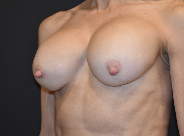 Breast Revision Gallery - Patient 121234776 - Image 3
