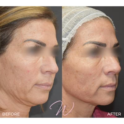 Sylfirm X Microneedling Gallery - Patient 123000384 - Image 1