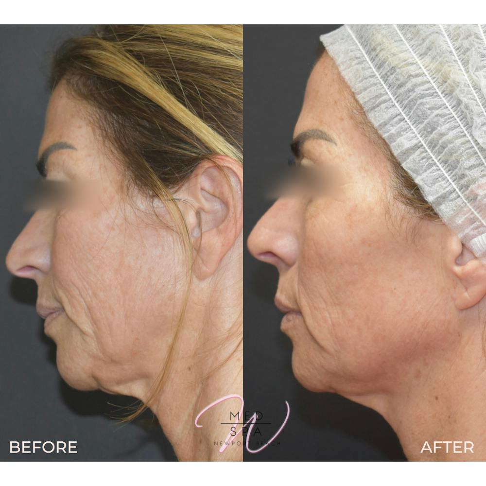 Laser Treatments Before & After Gallery - Patient 123000389 - Image 2