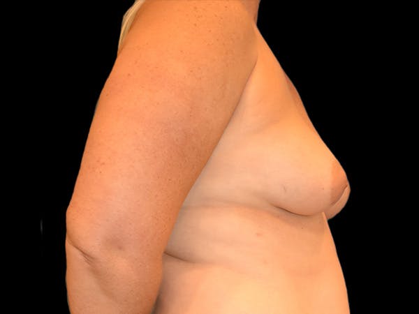 Breast Augmentation Before & After Gallery - Patient 13574569 - Image 3
