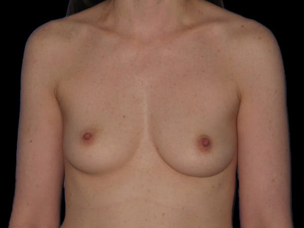 Breast Augmentation Before & After Gallery - Patient 13574609 - Image 1