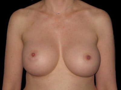 Breast Augmentation Before & After Gallery - Patient 13574609 - Image 2