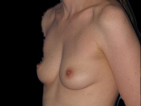 Breast Augmentation Before & After Gallery - Patient 13574609 - Image 3