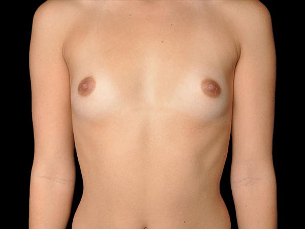 Breast Augmentation Before & After Gallery - Patient 13574614 - Image 1