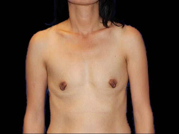 Breast Augmentation Before & After Gallery - Patient 13574615 - Image 1